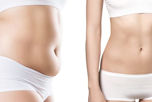 tarrusmorell-abdominoplastia